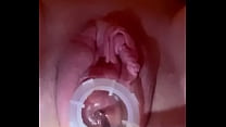 Electrosound du col de l'utérus et orgasme vibe