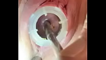 Watch 8mm electrosound puckering my cervix as I squeal from