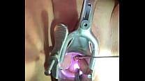 Penetración del útero con dilatador de capullo de rosa