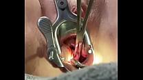 Holding cervix w tenaculum while 8mm dilator fucks uterus