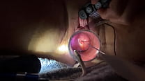 Electrosounding inside uterus